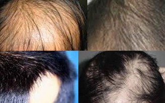Ngăn chặn, điều trị hiệu quả bệnh rụng tóc