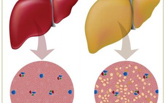 Đừng coi thường gan nhiễm mỡ