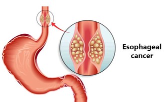 Khó nuốt thức ăn, coi chừng mắc bệnh nguy hiểm này