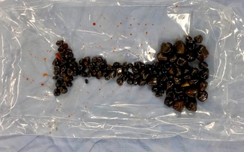 Đà Nẵng: Phẫu thuật nội soi lấy ra hàng trăm viên sỏi mật