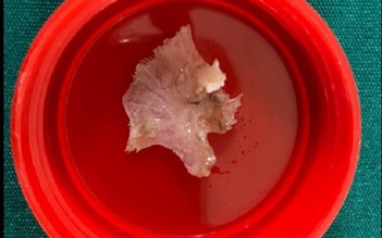Nội soi gắp mảnh xương cá sắc nhọn nằm trong thực quản ra ngoài