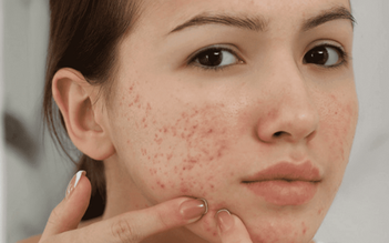 Top 10 kem trị mụn viêm hiệu quả do chuyên da liễu 'tiến cử'