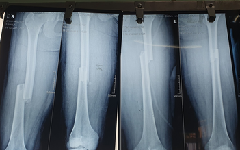 Nối xương đùi cả 2 chân cùng lúc cho bệnh nhi bị đa chấn thương