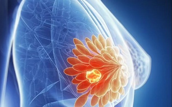 Phát hiện đột phá có thể ngăn ung thư vú tái phát đến hàng chục năm