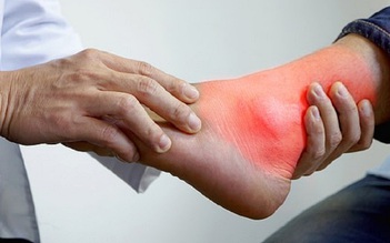 Bị gout, cần tập luyện thể thao thế nào?