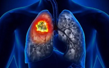4 yếu tố gây ung thư phổi đối với người không hút thuốc