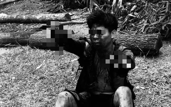 Quảng Ninh: Đánh cá bằng mìn, nam thanh niên bị đứt rời tay