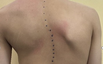 Nữ sinh bị biến dạng cột sống do nhiều năm không điều trị