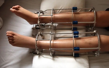 Phẫu thuật kéo dài chân đang trở nên phổ biến với người trẻ