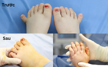 Hiếm gặp: Bệnh nhi thừa ngón, có đến 12 ngón tay, 12 ngón chân