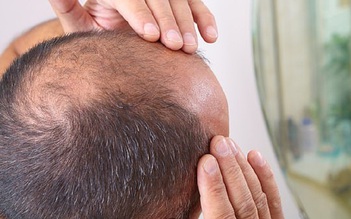 Vì sao nhổ tóc bạc có thể gây hói?