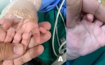 Phẫu thuật tạo hình cho bé gái có 24 ngón tay chân, bị dư ngón, dính ngón
