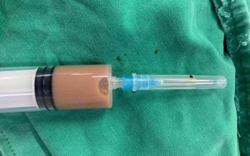 Cấp cứu do ổ áp xe lưng chứa đầy dịch mủ sau tiêm thuốc của thầy lang