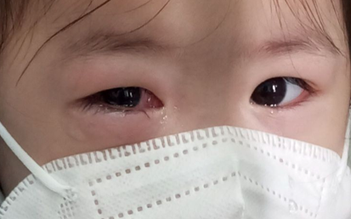 Phát hiện học sinh triệu chứng đau mắt đỏ, nhà trường cần làm gì?