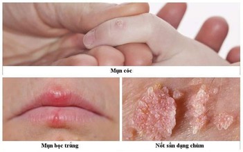 Làm sao để tránh những căn bệnh ngoài da dễ lây khi sống tập thể?