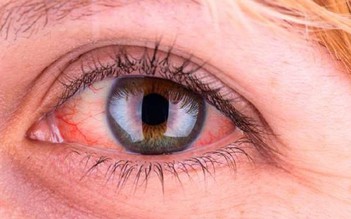 Vì sao nên ngủ riêng, cách ly tương đối khi đau mắt đỏ?