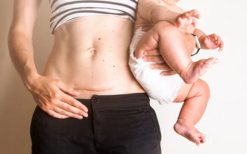 Bí quyết xóa mờ sẹo sau sinh mẹ cần tham khảo ngay