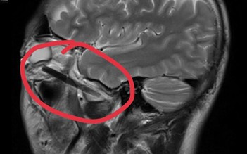 Hy hữu: Đầu đũa dài 6 cm nằm trong hốc mắt mà người đàn ông không biết