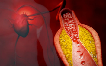 3 triệu chứng thường gặp cảnh báo xơ vữa động mạch