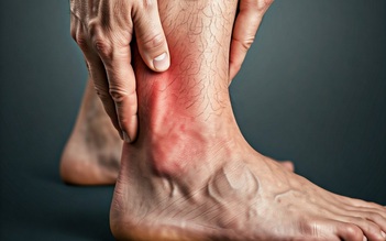 4 dấu hiệu đau mắt cá chân là do bệnh gout