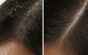 Làm thế nào để trị gàu hiệu quả?