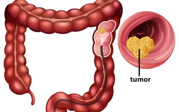 Vị thuốc đông y có tiềm năng điều trị ung thư đại tràng giai đoạn cuối