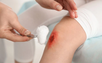Vết thương hở là gì và cách vệ sinh vết thương hở hằng ngày