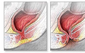 Phát hiện sớm trẻ sơ sinh không có lỗ hậu môn trong hiếm gặp