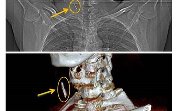 Khám sức khỏe, phát hiện chiếc đinh rỉ trong cổ bệnh nhân