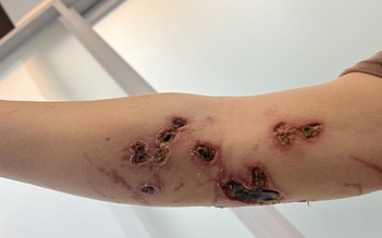 TP.HCM: Nhiều người bị nổi hồng ban sưng nề da do tiếp xúc sứa biển