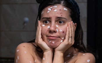 Mẹo chăm sóc da thủy đậu ít để lại sẹo