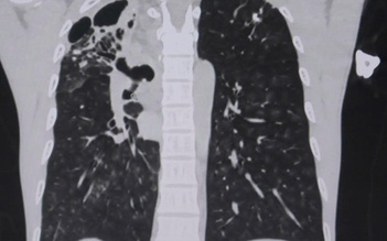 Người đàn ông ho ra cả chén máu vì vỡ mạch máu phế quản