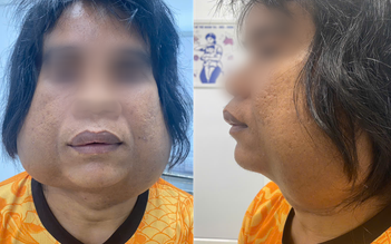 Choáng: Nam thanh niên sống cùng 2 khối u khổng lồ trên mặt suốt 10 năm