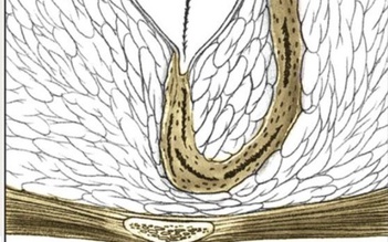 Bệnh tổ lông vùng cùng cụt