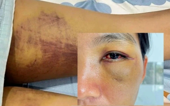 Lâm Đồng: Bắt giữ chồng cũ nạn nhân trong vụ ‘tra tấn em dâu để trừ tà’