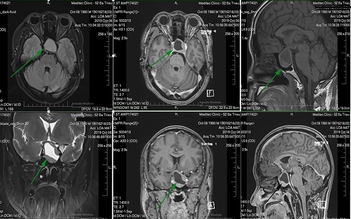 Khát nước dữ dội, bệnh gì?