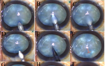 Bác sĩ Việt công bố nghiên cứu mới trên tạp chí nhãn khoa hàng đầu thế giới