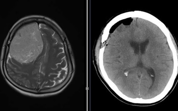 Đau đầu, yếu nửa người, khám bệnh phát hiện khối u màng não nặng 600 gram