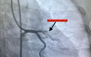 1 ngày 4 ca nhồi máu cơ tim cấp nhập viện, có bất thường?