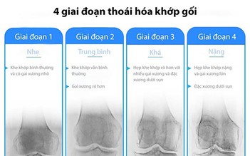 Cảnh báo: Lỡ giai đoạn vàng hồi sinh khớp gối, nhiều người gánh hệ lụy nghiêm trọng