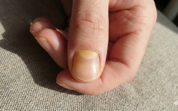 Giải mã hình bán nguyệt ở móng tay