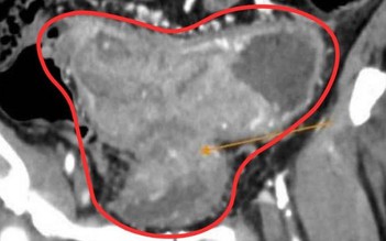 Từ chối mổ, tự ý dùng thuốc nam, bệnh nhân ung thư chuyển nặng