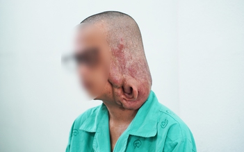 Bệnh viện Chợ Rẫy 'trả lại' gương mặt cho bệnh nhân bị u khủng làm biến dạng