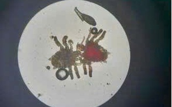 Người đàn ông 56 tuổi bị ngứa dữ dội do rận ký sinh