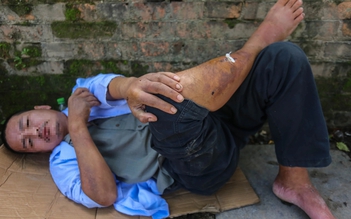 10 ngày sau vụ bị nhóm thiếu niên đánh đập, người đàn ông ở Huế vẫn chưa bình phục