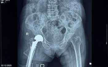 Thay khớp háng thành công cho cụ bà 100 tuổi