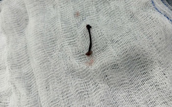 Tắm suối, bé trai 30 tháng tuổi bị vắt chui vào mũi