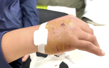 Bác sĩ hướng dẫn xử trí khi bị chó cắn