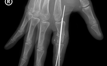 Cứu sống ngón tay thủy thủ bị đứt rời sau 25 giờ