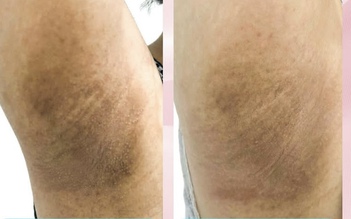 Bệnh nhân nữ khổ sở vì đổ nhiều mồ hôi